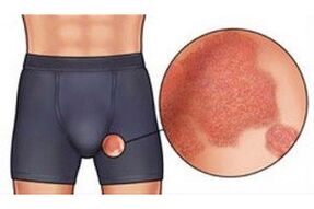 A schistomatosis az emberi nemi szerveket érinti, súlyos viszketést okozva